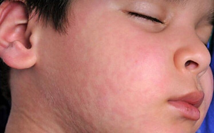 Allergilised lööbed nahal - sümptom parasiitide usside esinemisest kehas